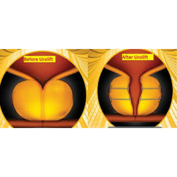 Urolift